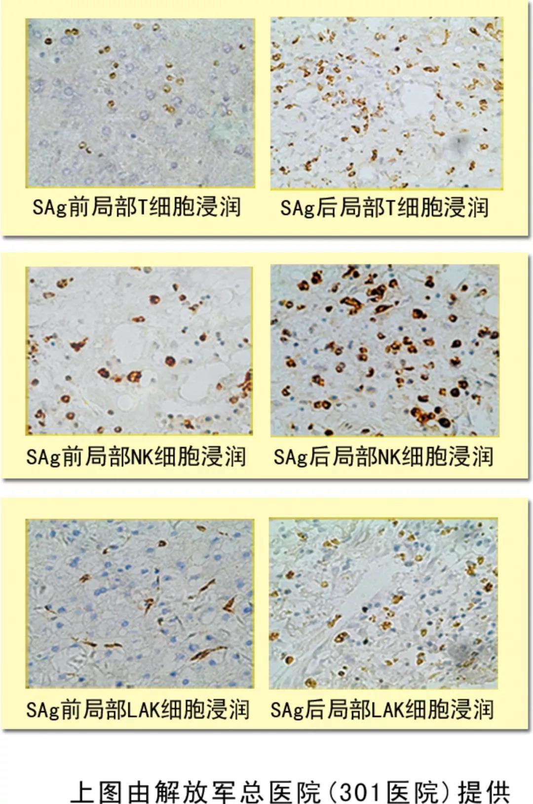 NK细胞，抗癌的第一道防线